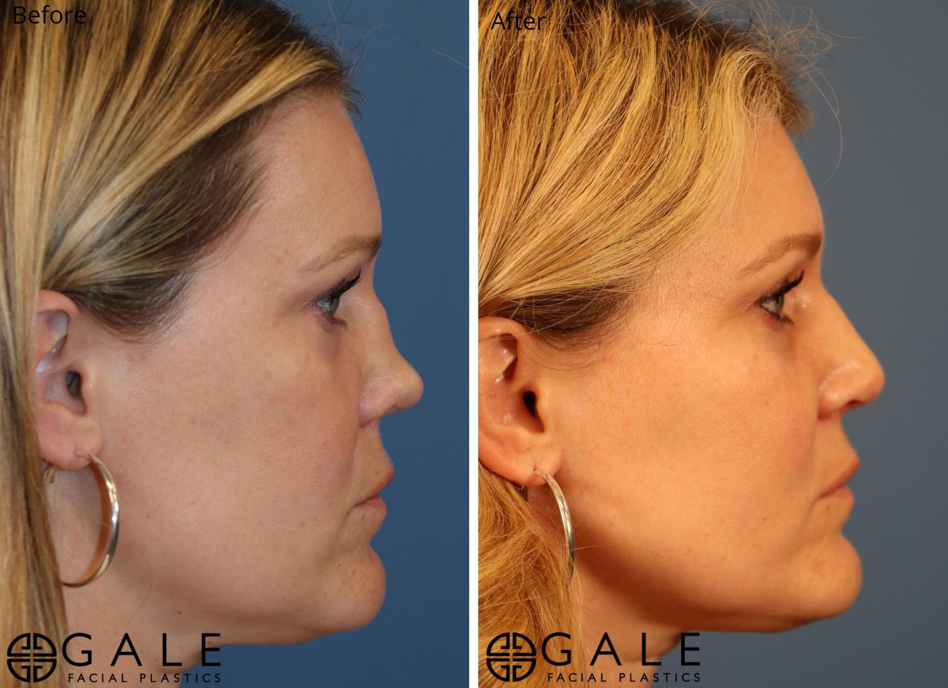 Gale Facial Plastics rhinoplasty result — Riverton, UT