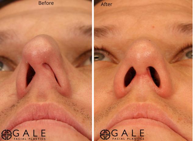 Rhinoplasty result at Gale Facial Plastics in Riverton, UT