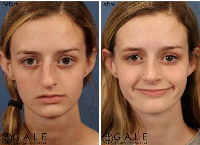 Rhinoplasty result at Gale Facial Plastics in Riverton, UT