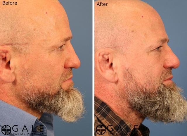 Rhinoplasty result at Gale Facial Plastics in Riverton, UT