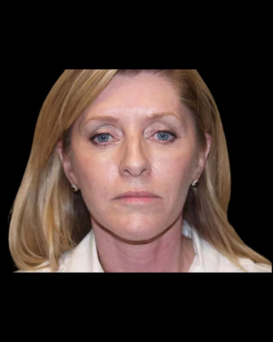 Folsom Plastic Surgery facelift after — Folsom, CA