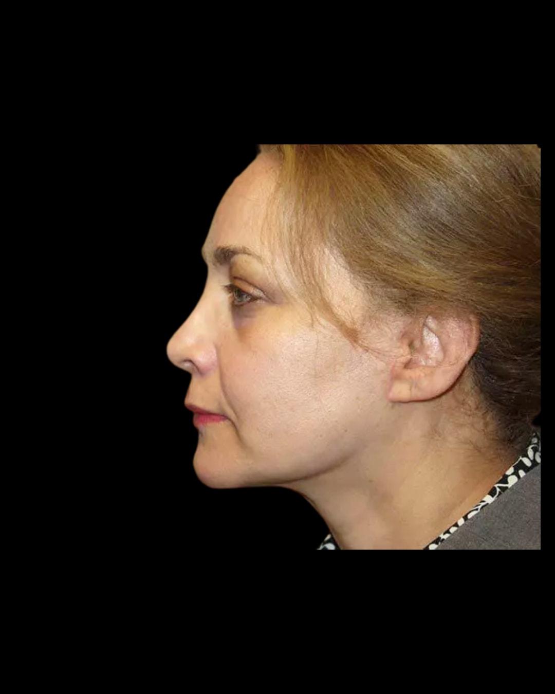 Folsom Plastic Surgery facelift after — Folsom, CA