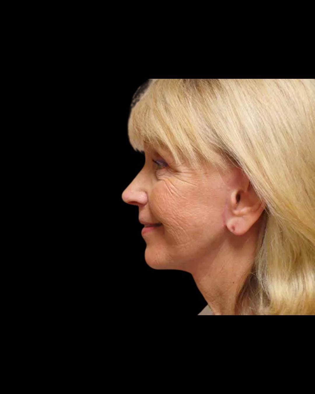 Folsom Plastic Surgery facelift after — Folsom, CA