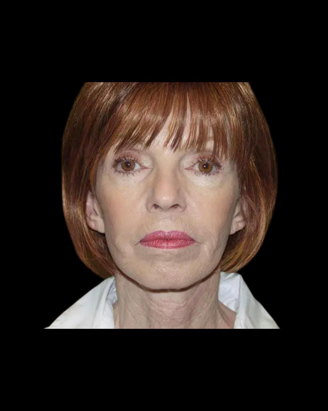 Folsom Plastic Surgery facelift after — Folsom, CA