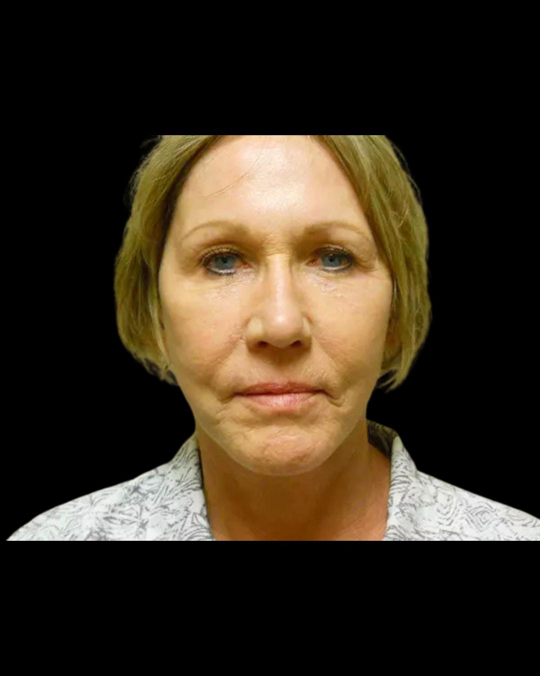 Folsom Plastic Surgery facelift after — Folsom, CA