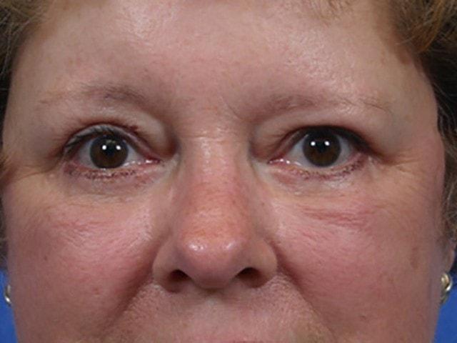 Brow Lift after at Dr. Ali Plastic Surgery & Amae Medspa in Birmingham, MI