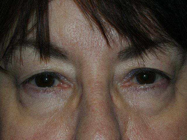 Brow Lift before at Dr. Ali Plastic Surgery & Amae Medspa in Birmingham, MI