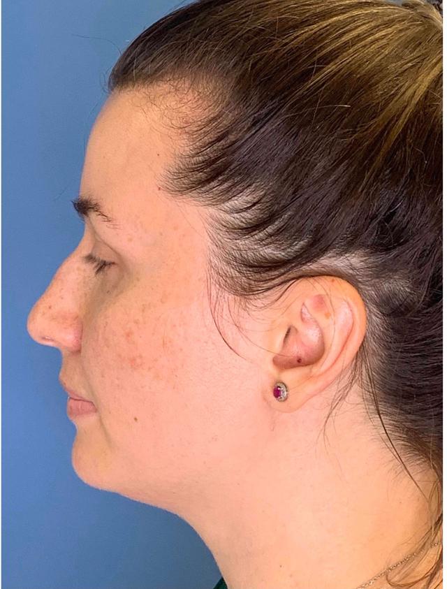 Rhinoplasty before at Dr. Ali Plastic Surgery & Amae Medspa in Birmingham, MI