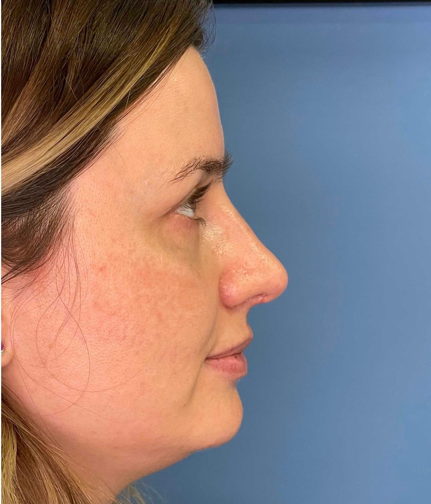 Dr. Ali Plastic Surgery & Amae Medspa rhinoplasty after — Birmingham, MI
