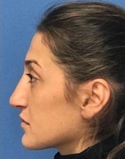 Dr. Ali Plastic Surgery & Amae Medspa rhinoplasty after — Birmingham, MI