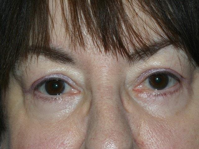 Brow Lift after at Dr. Ali Plastic Surgery & Amae Medspa in Birmingham, MI