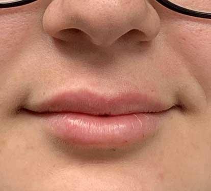 Dr. Ali Plastic Surgery & Amae Medspa lip filler after — Birmingham, MI