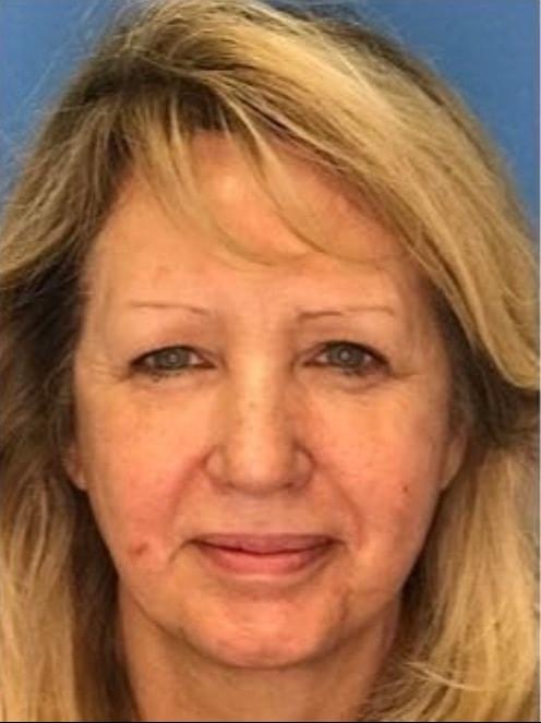 Mini Facelift after at Dr. Ali Plastic Surgery & Amae Medspa in Birmingham, MI