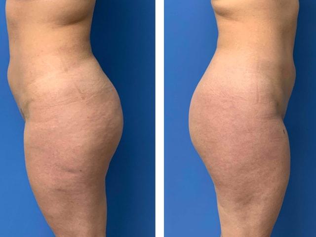 Liposuction after at Dr. Ali Plastic Surgery & Amae Medspa in Birmingham, MI