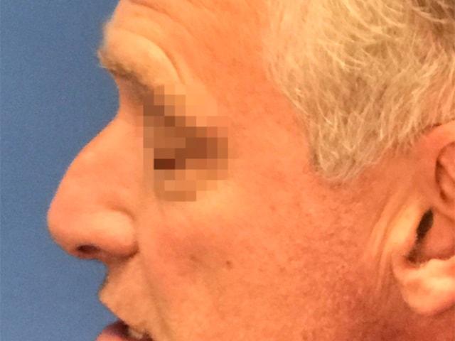 Rhinoplasty before at Dr. Ali Plastic Surgery & Amae Medspa in Birmingham, MI