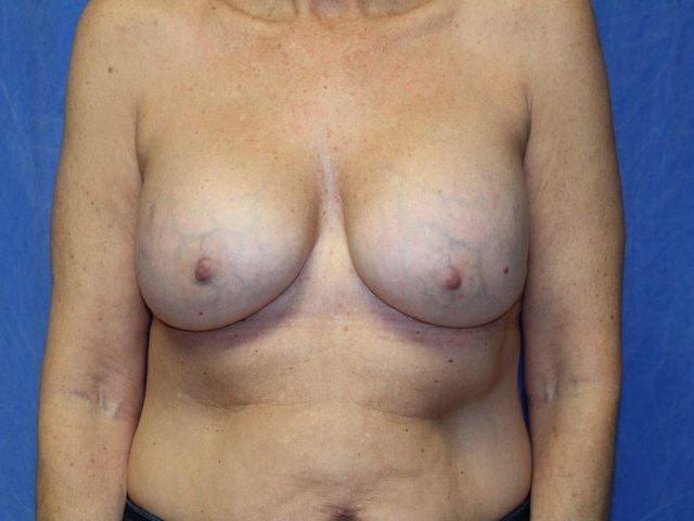 Breast Augmentation after at Dr. Ali Plastic Surgery & Amae Medspa in Birmingham, MI