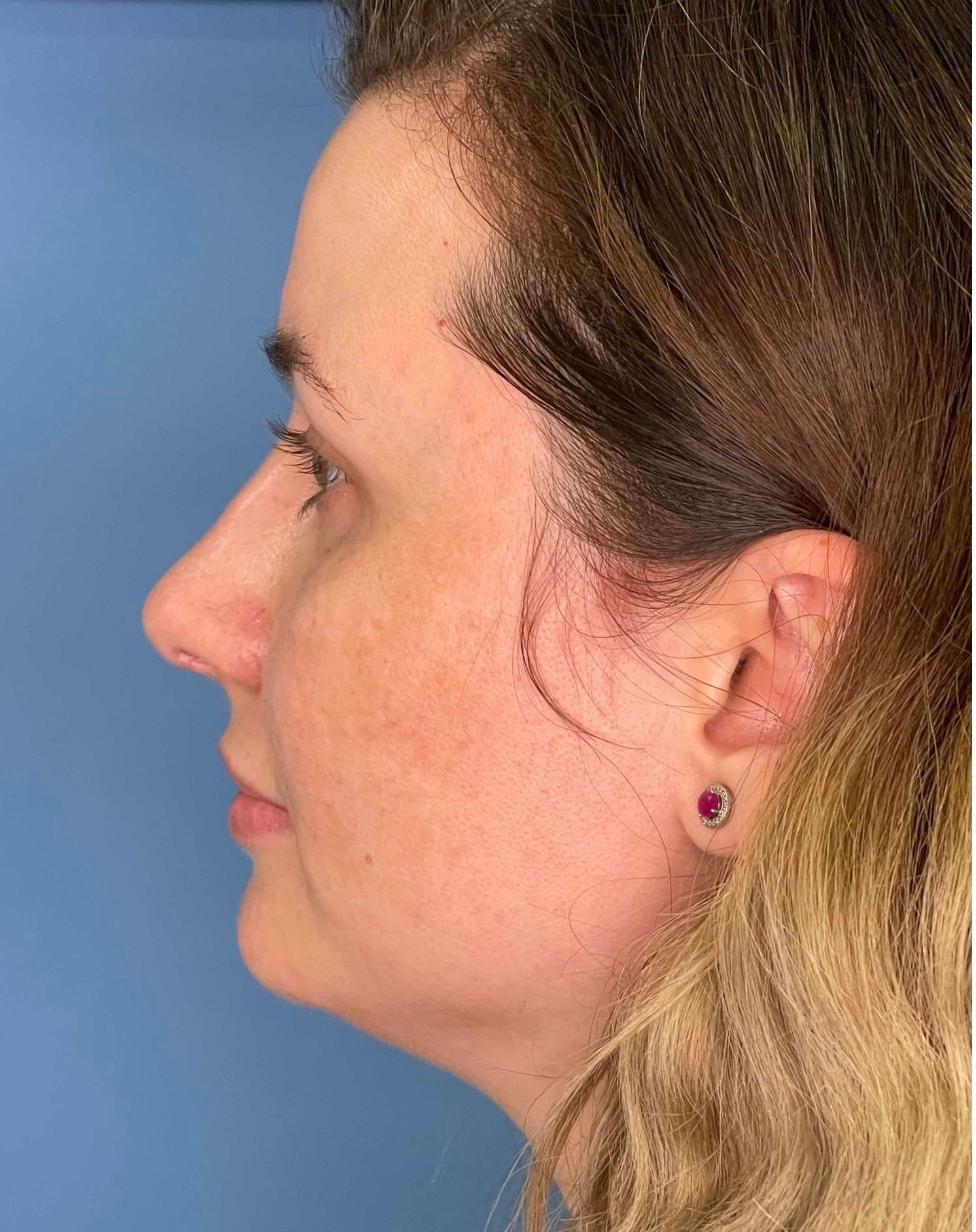 Dr. Ali Plastic Surgery & Amae Medspa rhinoplasty after — Birmingham, MI