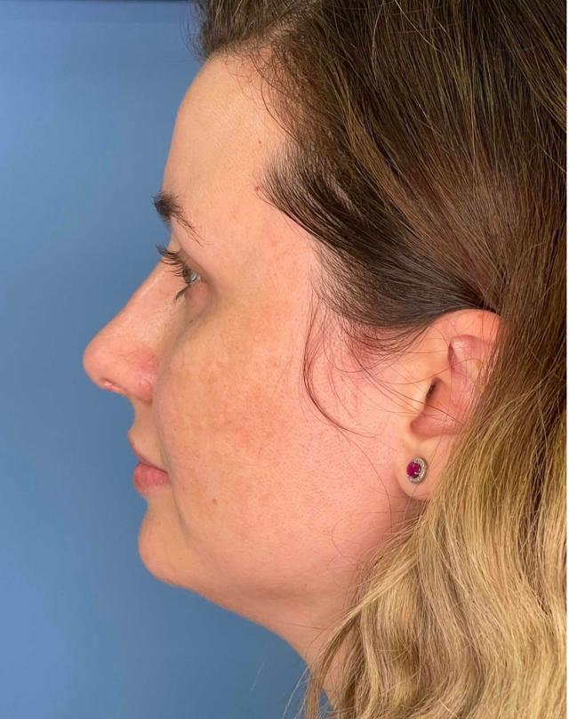 Rhinoplasty after at Dr. Ali Plastic Surgery & Amae Medspa in Birmingham, MI