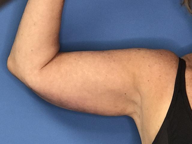 Arm Lift after at Dr. Ali Plastic Surgery & Amae Medspa in Birmingham, MI