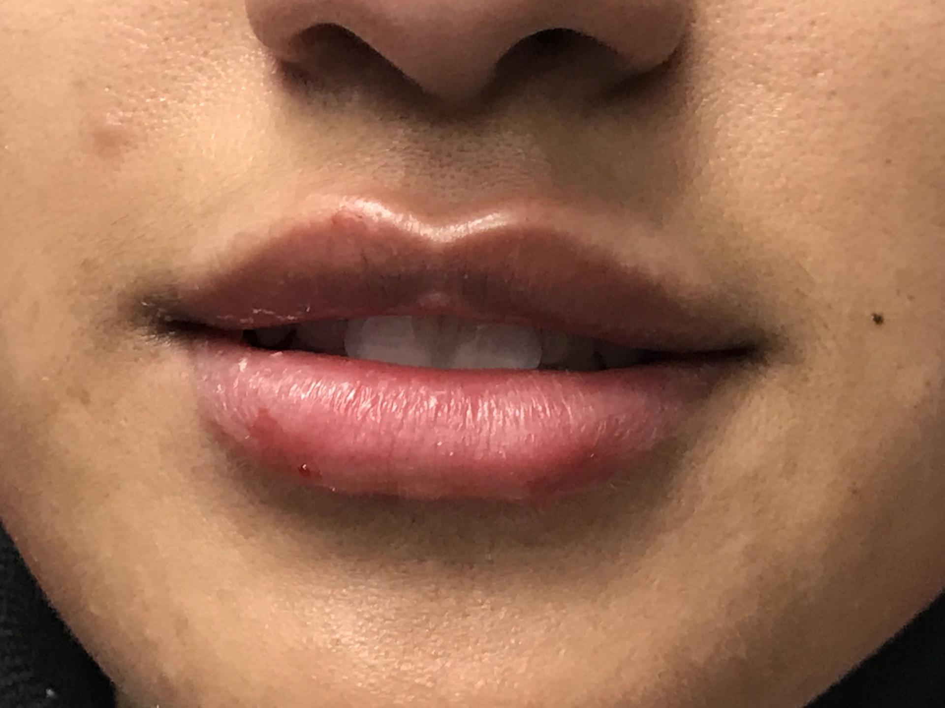 Dr. Ali Plastic Surgery & Amae Medspa lip filler after — Birmingham, MI