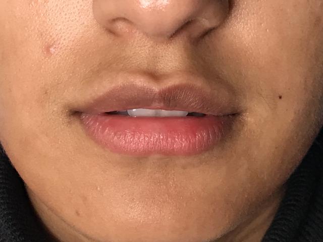 Juvederm before at Dr. Ali Plastic Surgery & Amae Medspa in Birmingham, MI