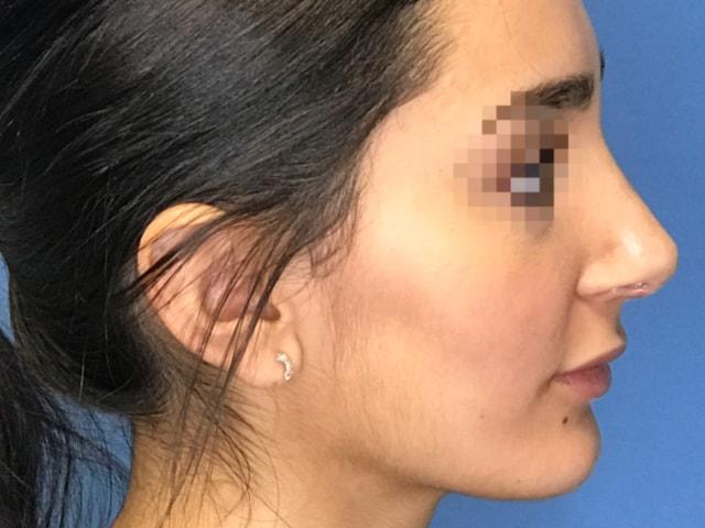 Dr. Ali Plastic Surgery & Amae Medspa rhinoplasty after — Birmingham, MI
