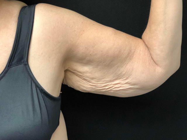 Arm Lift before at Dr. Ali Plastic Surgery & Amae Medspa in Birmingham, MI