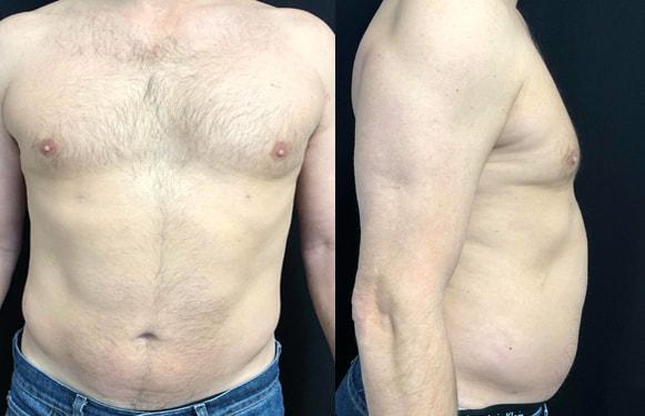 Liposuction after at Dr. Ali Plastic Surgery & Amae Medspa in Birmingham, MI