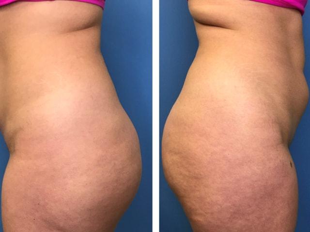 Liposuction before at Dr. Ali Plastic Surgery & Amae Medspa in Birmingham, MI