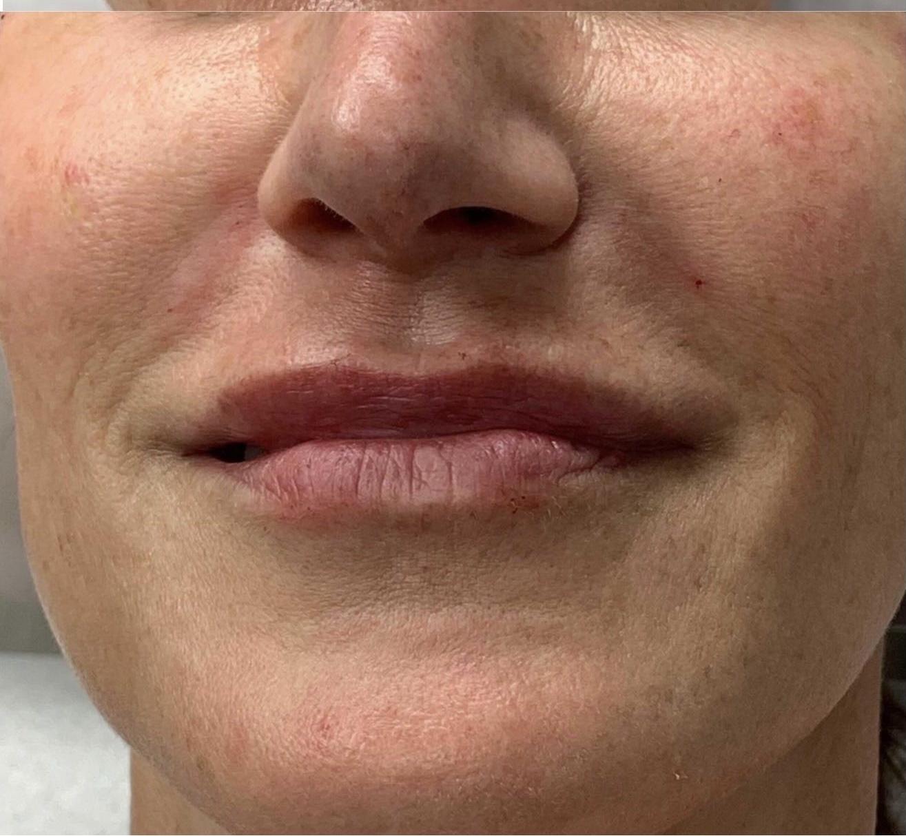 Dr. Ali Plastic Surgery & Amae Medspa lip filler after — Birmingham, MI