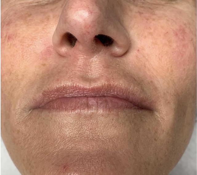 Juvederm before at Dr. Ali Plastic Surgery & Amae Medspa in Birmingham, MI