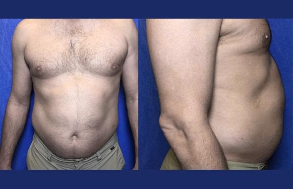 Liposuction before at Dr. Ali Plastic Surgery & Amae Medspa in Birmingham, MI