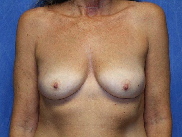 Breast Augmentation before at Dr. Ali Plastic Surgery & Amae Medspa in Birmingham, MI