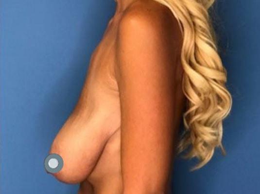 Breast Lift before at Dr. Ali Plastic Surgery & Amae Medspa in Birmingham, MI