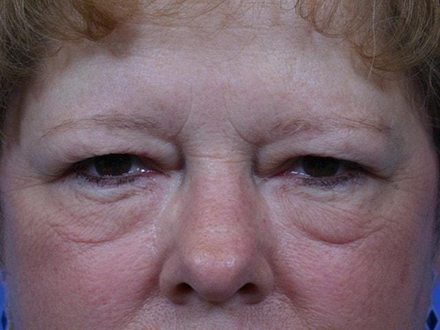 Brow Lift before at Dr. Ali Plastic Surgery & Amae Medspa in Birmingham, MI