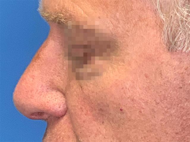 Rhinoplasty after at Dr. Ali Plastic Surgery & Amae Medspa in Birmingham, MI