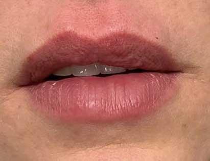 Juvederm after at Dr. Ali Plastic Surgery & Amae Medspa in Birmingham, MI