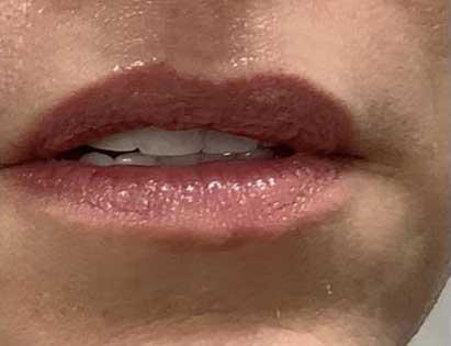 Juvederm before at Dr. Ali Plastic Surgery & Amae Medspa in Birmingham, MI