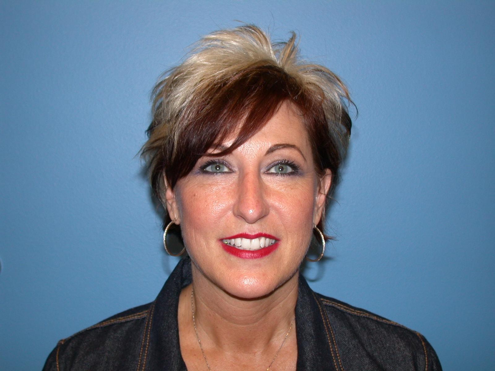Pacifica Cosmetic Surgery Center facelift after — Newport Beach, CA