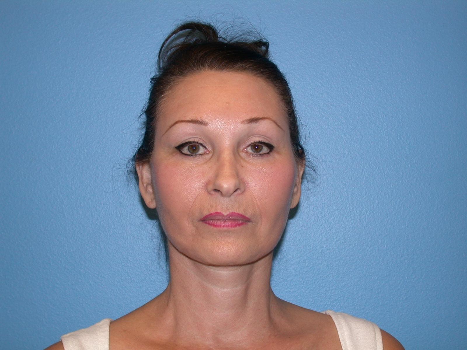 Pacifica Cosmetic Surgery Center facelift after — Newport Beach, CA