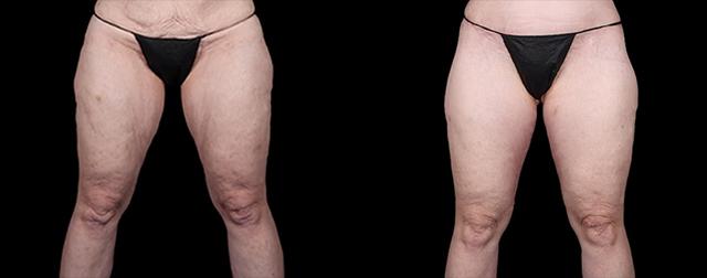 Thigh Lift result at Avante Plastic Surgery in Houston, TX