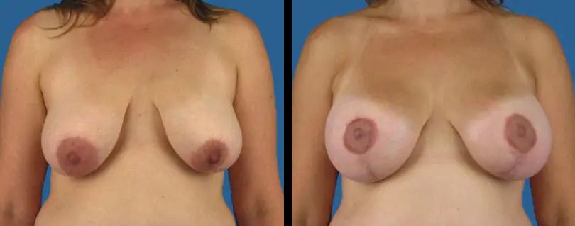 Avante Plastic Surgery breast lift result — Houston, TX