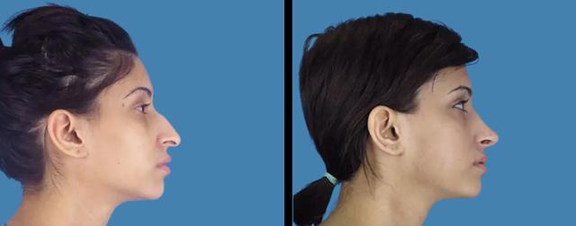 Rhinoplasty result at Avante Plastic Surgery in Sugar Land, TX