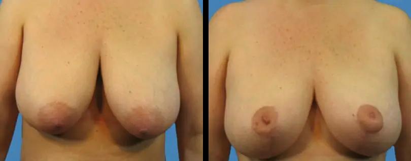 Avante Plastic Surgery breast lift result — Houston, TX