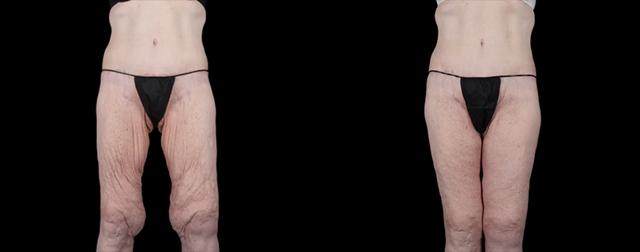 Thigh Lift result at Avante Plastic Surgery in Houston, TX