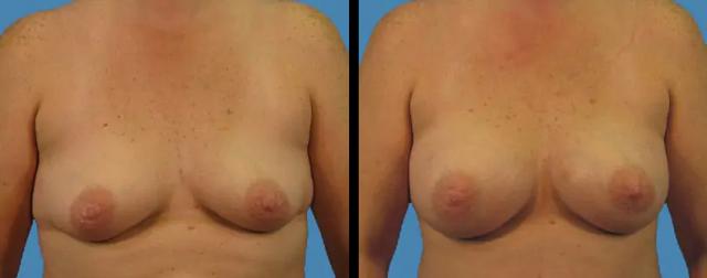 Breast Augmentation result at Avante Plastic Surgery in Sugar Land, TX