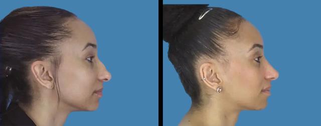 Liquid Rhinoplasty result at Avante Plastic Surgery in Houston, TX