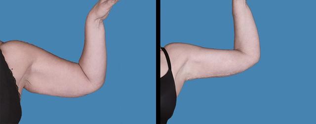 Arm Lift result at Avante Plastic Surgery in Sugar Land, TX