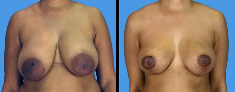 Avante Plastic Surgery breast lift result — Houston, TX