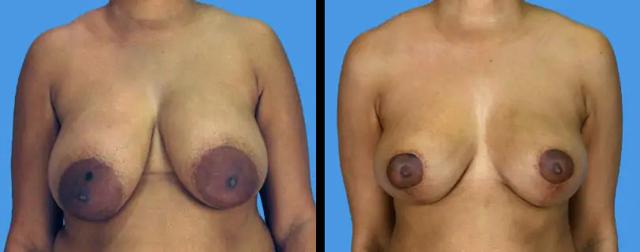Breast Lift result at Avante Plastic Surgery in Sugar Land, TX
